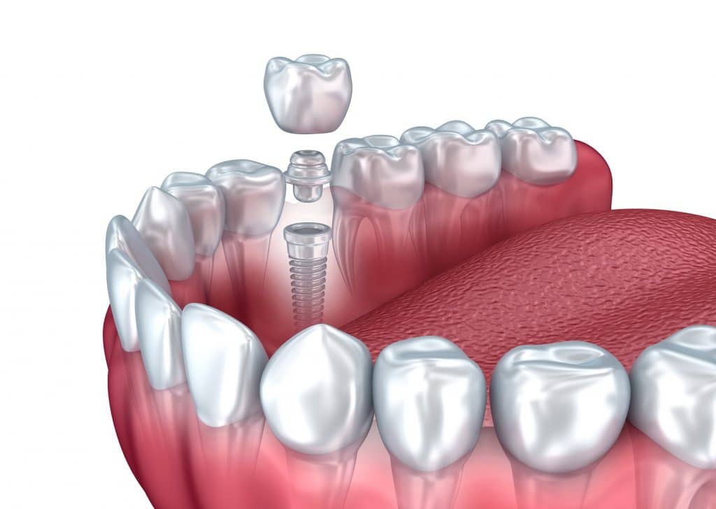 The Underlying Importance of Implanted Replacement Teeth Leawood, KS