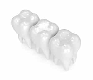 3d render of teeth with dental composite filling over white background