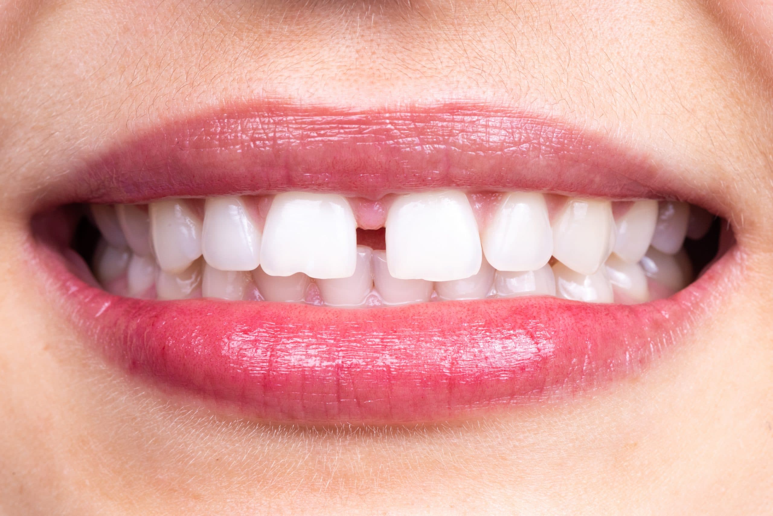 Diastema between tooth. Spacing between front teeth