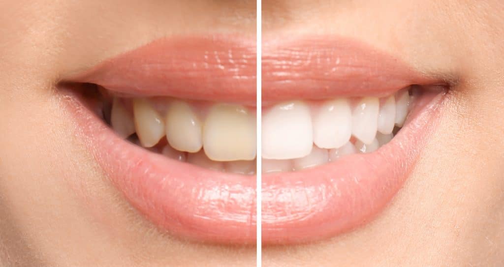 Smiling woman before and after teeth whitening procedure, closeup