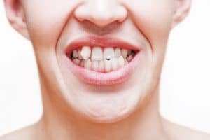 Young man showing crooked growing teeth. The man needs to go to the dentist to install braces.