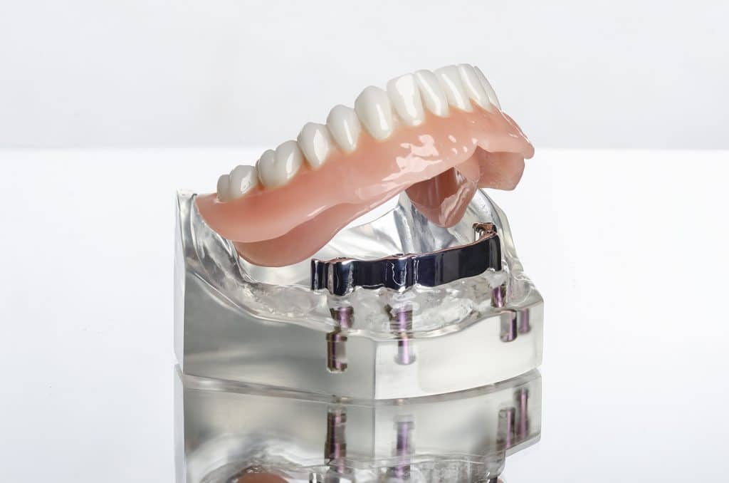 Zahn Implantat und Prothese Unterkiefer komplett