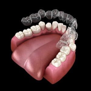 leawood invisalign