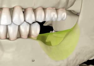 Mandibular Jaw, bone recession after losing molars teeth. Medically accurate dental 3D illustration