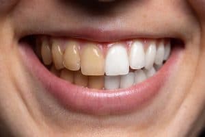 Before and after view of tooth whitening. A young Caucasian girl smiles wide and is seen close up. Showing the results of whiter teeth after a dentistry procedure.