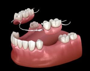 Removable partial denture, mandibular prosthesis. Medically accurate 3D illustration of prosthodontics concept