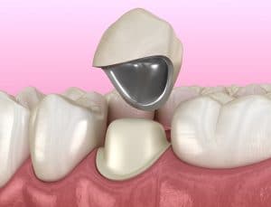 Preparated premolar tooth and dental metal-ceramic crown. Medically accurate 3D illustration