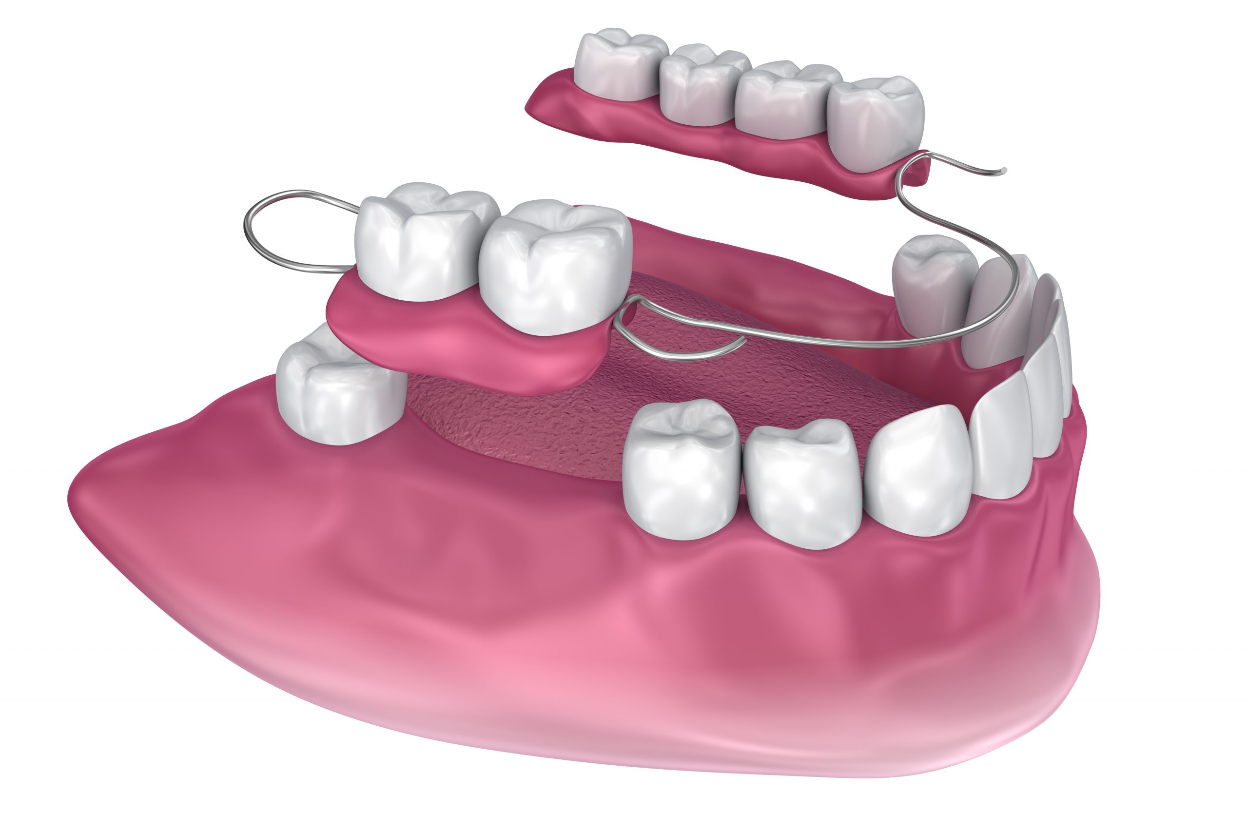 Removable partial denture. Medically accurate 3D illustration