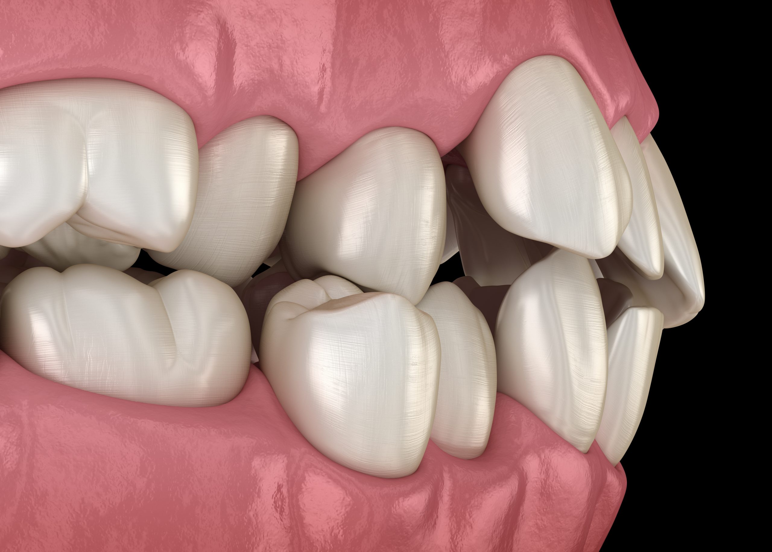 Abnormal teeth position, orthodontic concept. Medically accurate tooth 3D illustration