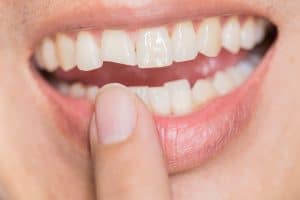 ugly smile dental problem. Teeth Injuries or Teeth Breaking in Male. Trauma and Nerve Damage of injured tooth, Permanent Teeth Injury.