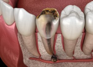 Periostitis tooth - Lump on Gum Above Tooth. Medically accurate dental 3D illustration