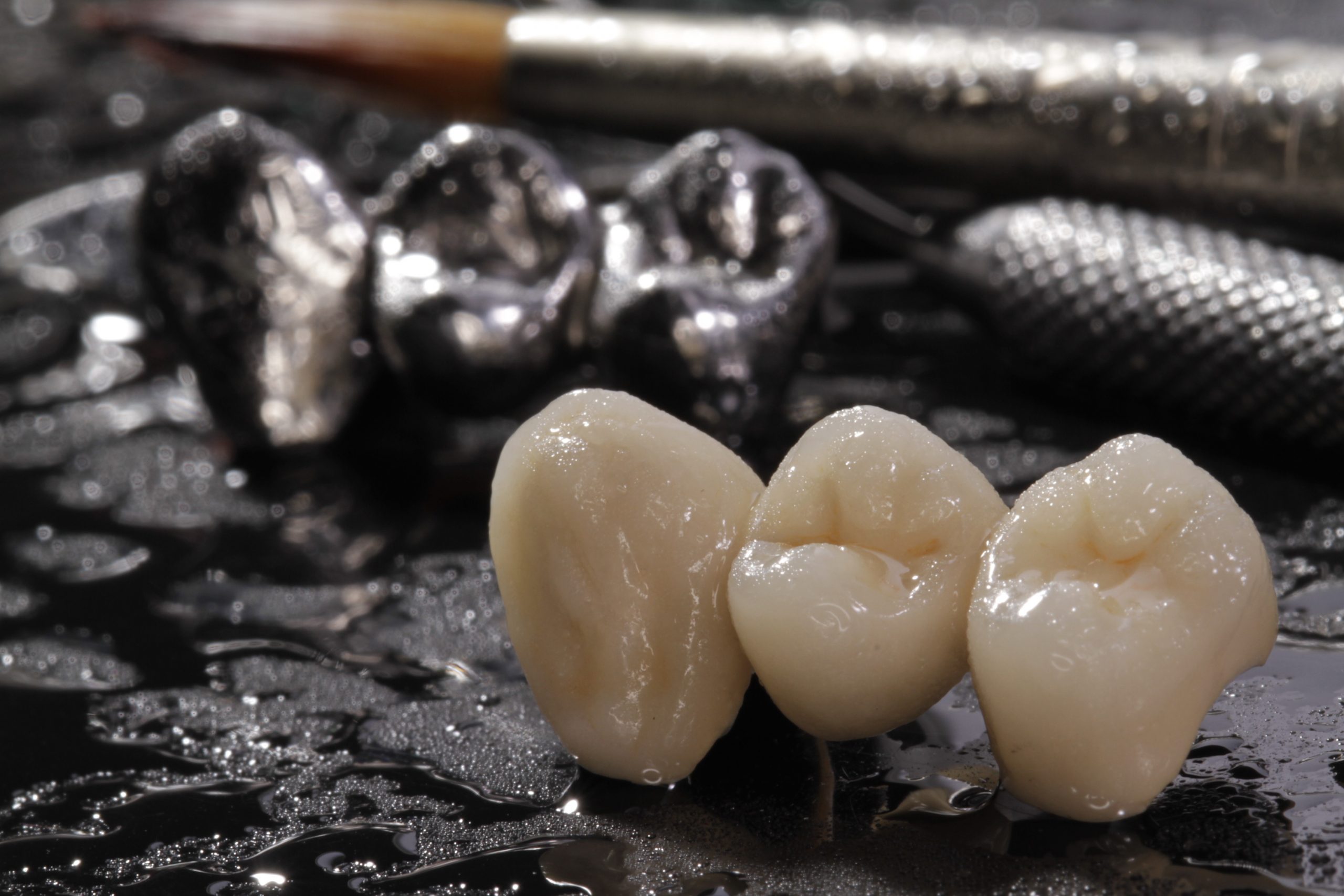 Macro E-max pressed ceramic bridge and metal crown with dentistry utensils