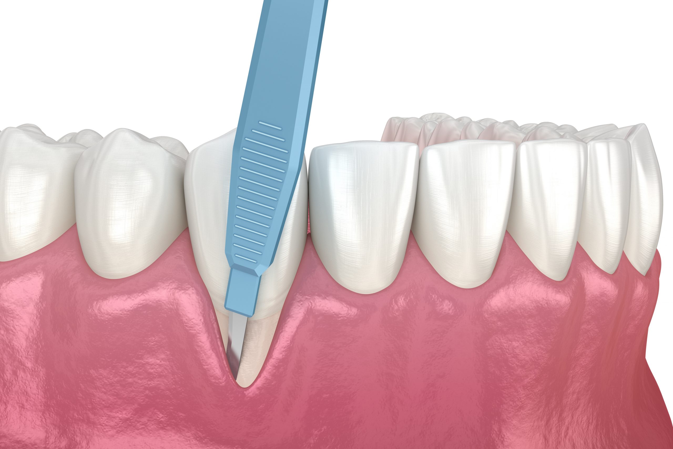 Gum Recession: Soft tissue graft surgery. 3D illustration of Dental treatment