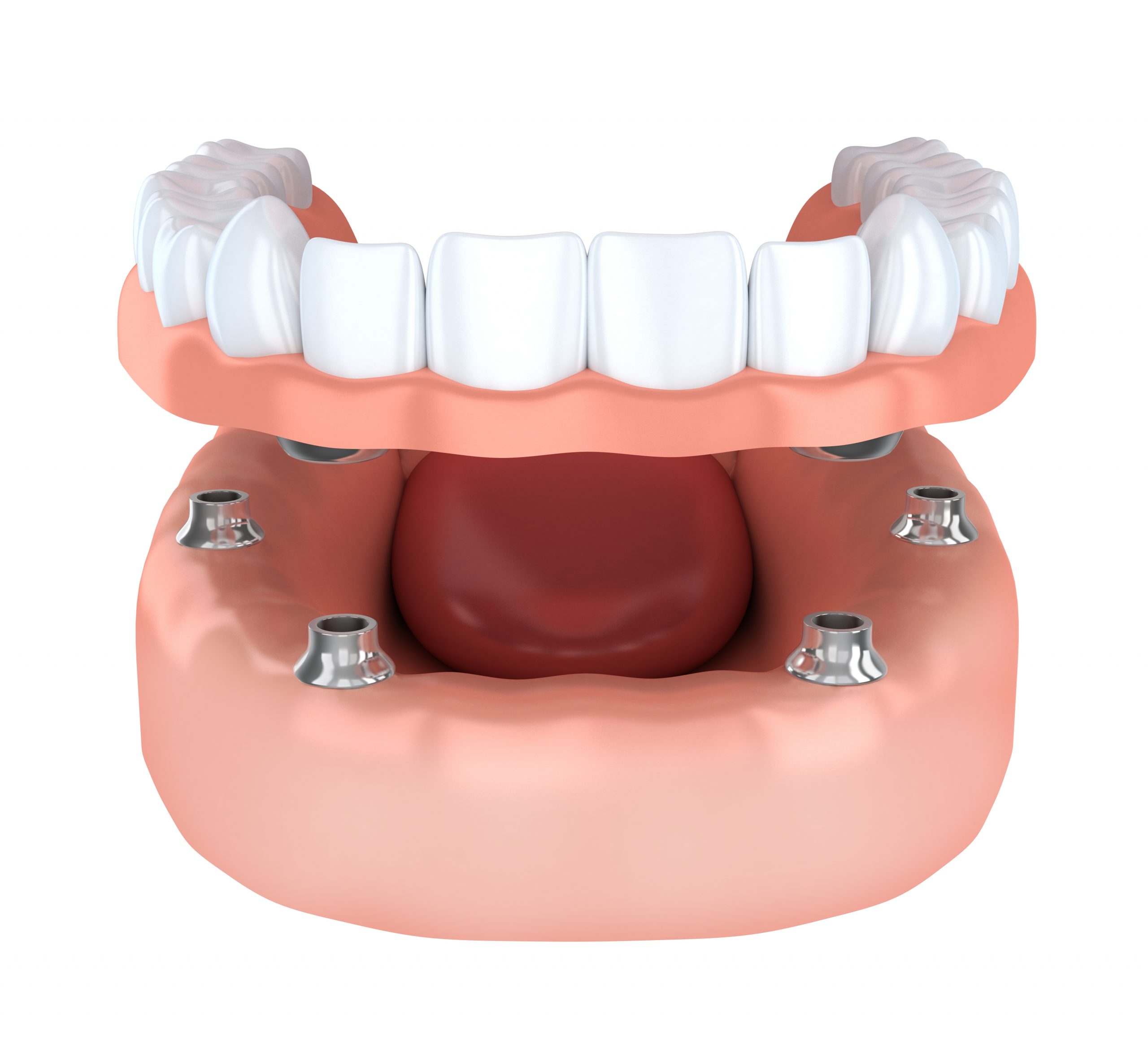 Tooth humman implantation, denture (done in 3d rendering)