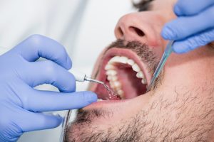 Plaque removal procedure