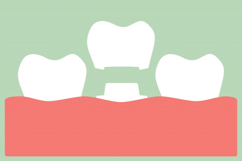 dental crown, installation process and change of teeth - tooth cartoon vector flat style cute character for design