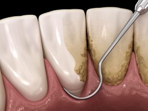 Oral hygiene: Scaling and root planing (conventional periodontal therapy). Medically accurate 3D illustration of human teeth treatment