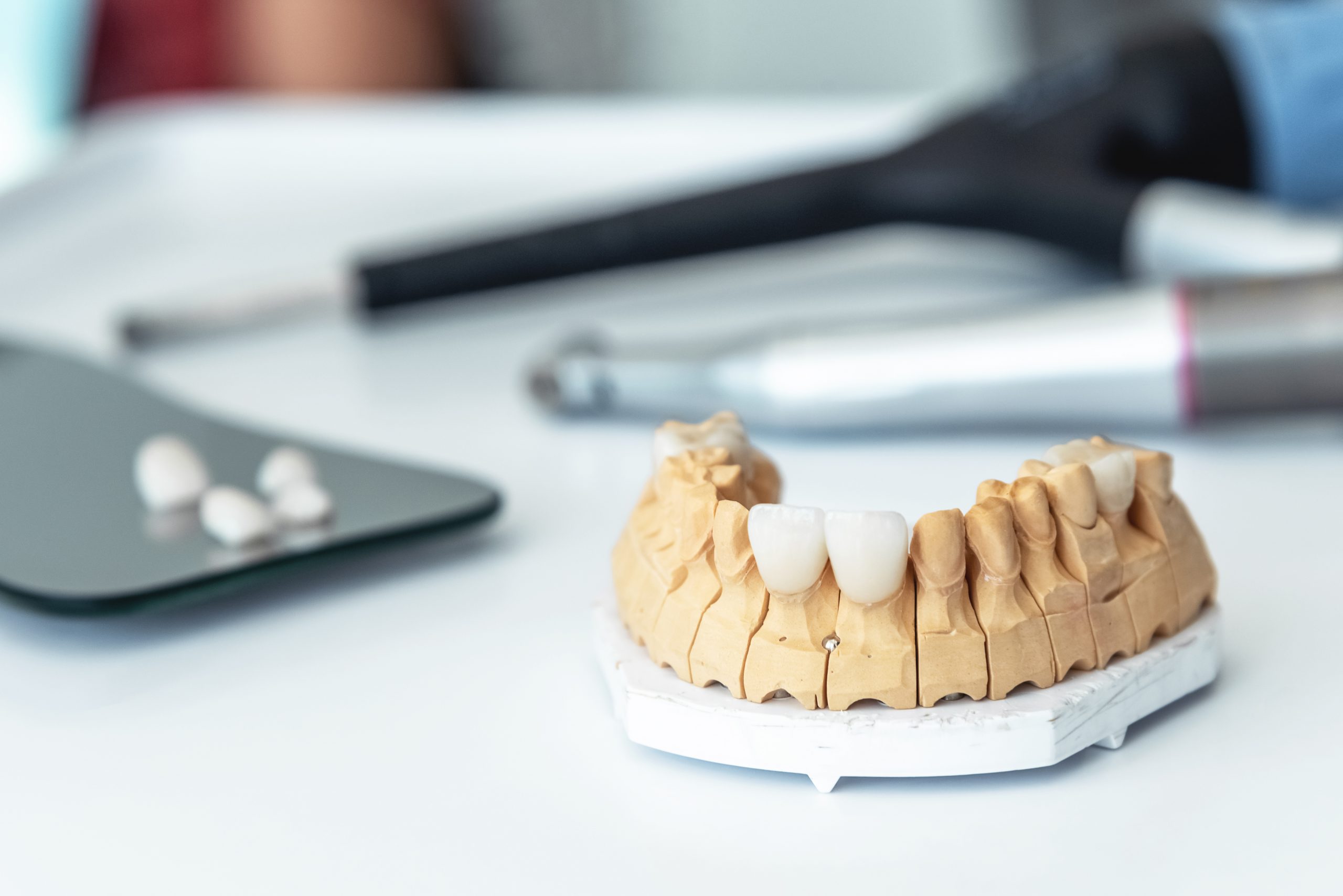 manufacture of veneers, dental implants and crowns in the dental laboratory. Maxillary denture with veneers in the dental office.
