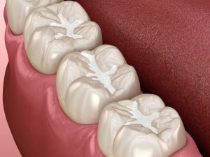 leawood dental fillings