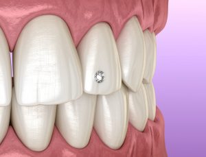 Tooth piercing by diamond, 3D illustration concept.