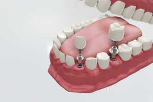 Dental Implants Treatment Procedure. Medically accurate 3D illustration dentures concept.