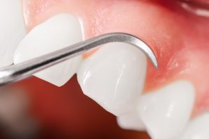 Gums and teeth examination. Close up