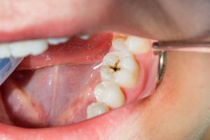 close-up of a human rotten carious tooth at the treatment stage in a dental clinic. The use of rubber dam system with latex scarves and metal clips, production of photopolymeric composite fillings