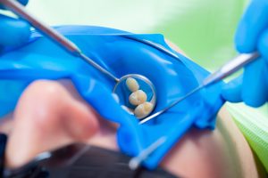 Close-up latex plate designed to isolate the tooth to be treated from the rest of the oral cavity during treatment. The dentist prepared the tooth for treatment.