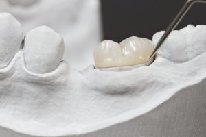 closeup for dental onlay on a molar tooth shown on a plaster model