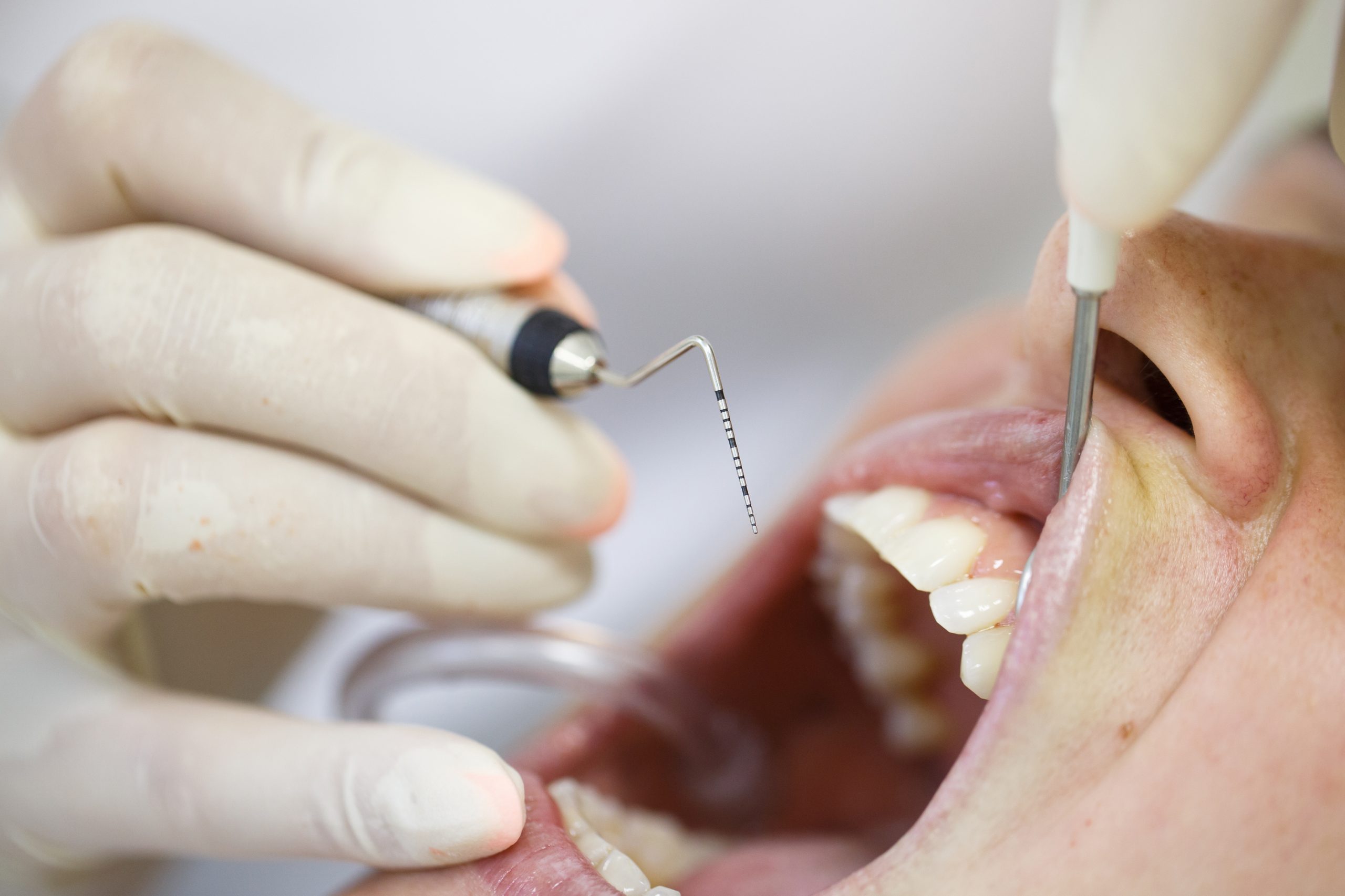 Periodontal probe, held by dental hygienist, measuring pocket depths around tooth, examining progression of periodontal disease. Dental hygiene, periodontal disease and prevention concept.