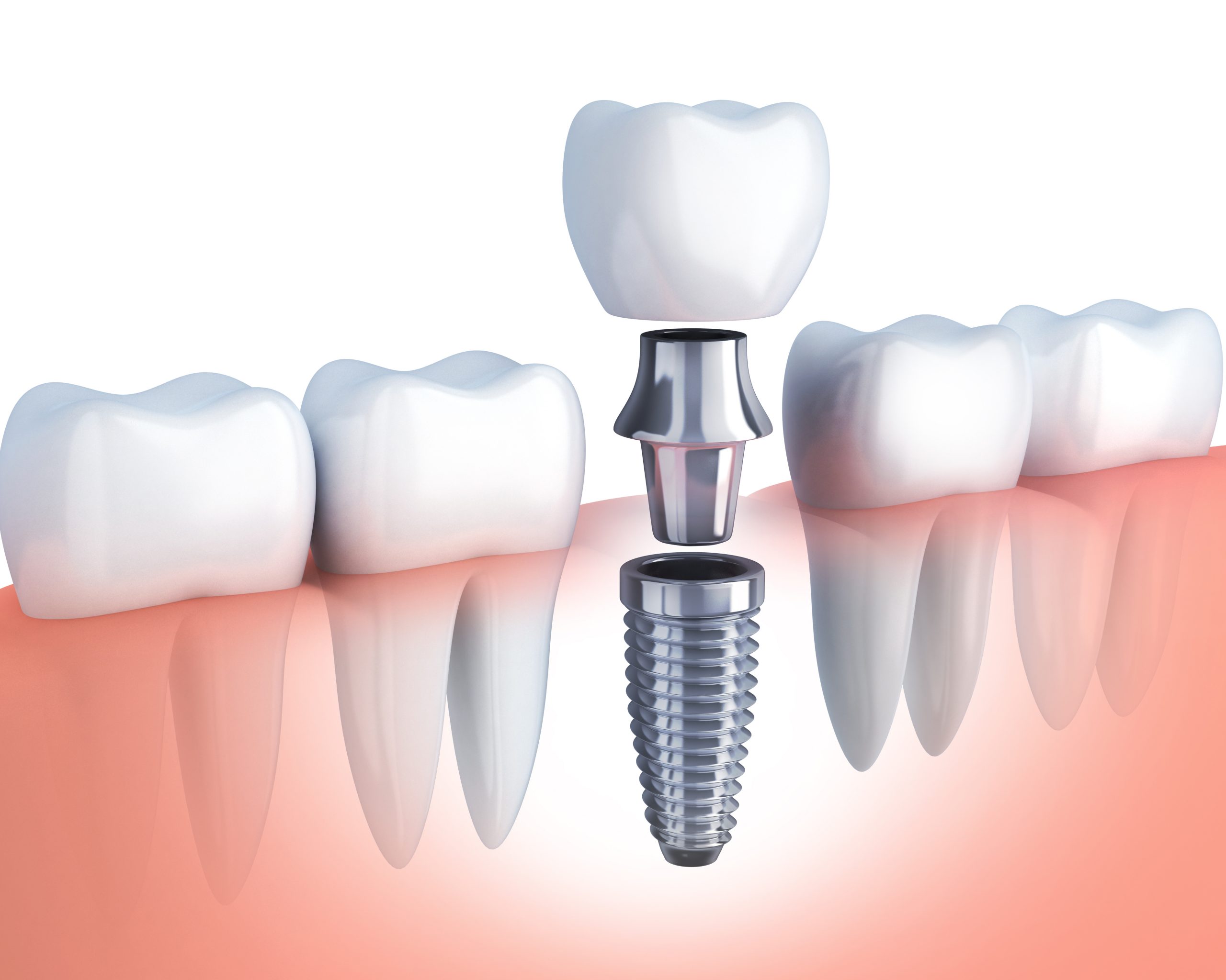 row human tooth and Dental implant. 3d illustration