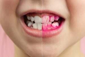 Plaque disclosing tablets in work. Before and after - effect. close up photo of young boy tooth. Dental plaque pill concept.