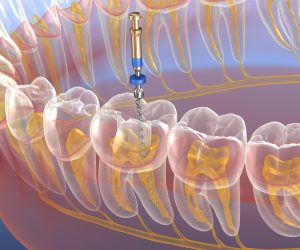 Endodontic root canal treatment process. Medically accurate tooth 3D illustration.