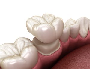 Preparated molar tooth for dental crown placement. Medically accurate 3D illustration