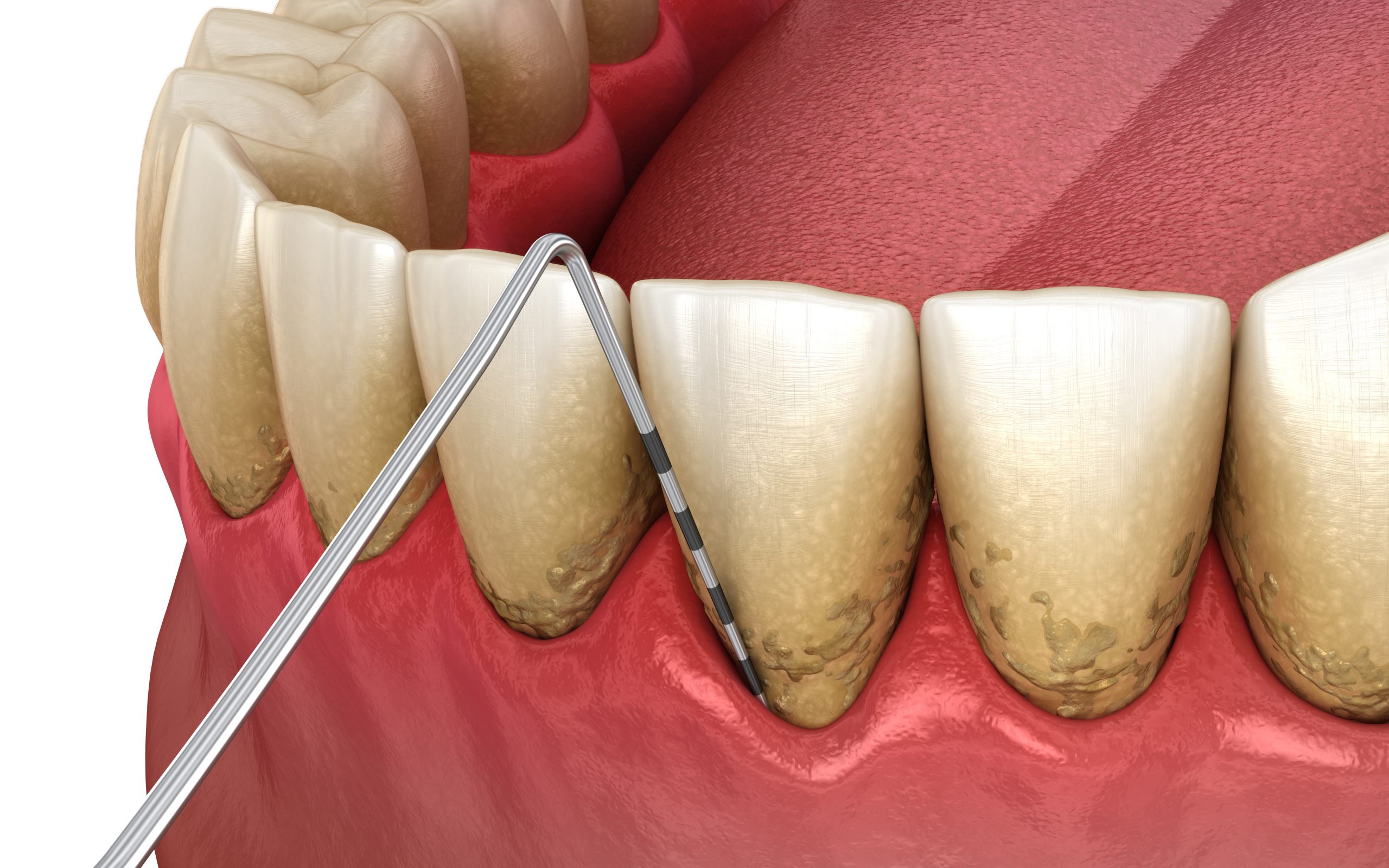 Periodontitis testing, gum recession process. Medically accurate 3D illustration