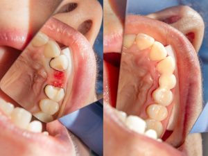 Restoration and sealing of a tooth with a fiberglass beam pin. Close-up photopolymer material using system Rabberdam in therapeutic dentistry