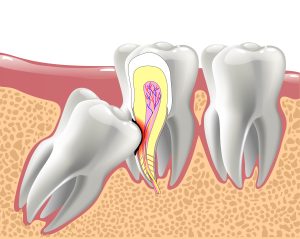 realistic 3D teeth, and wisdom tooth problems, oral anatomy