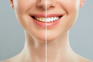 woman teeth before and after whitening. Over white background. Dental clinic patient. Image symbolizes oral care dentistry, stomatology.