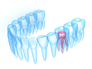 3d render of x-ray toothing with stainless steel dental post over white background. Endodontic treatment concept