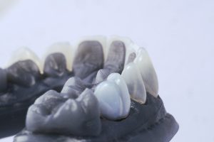 Close up of a dental model with veneers mounted on with dental t