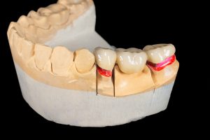 ceramic crowns of human teeth closeup macro isolate on black background. The concept aesthetic dentistry