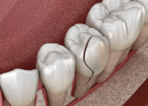 Cracked tooth, splitted. Medically accurate 3D illustration