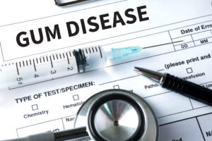 GUM DISEASE  Medical concept Doctor Gum disease stages