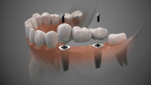 Tooth bridge human implant. Dental prosthetic innovation. 3d ill