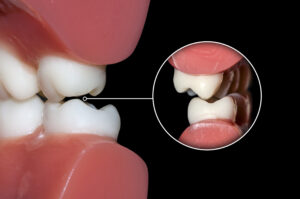 dental occlusion molars teeth close up