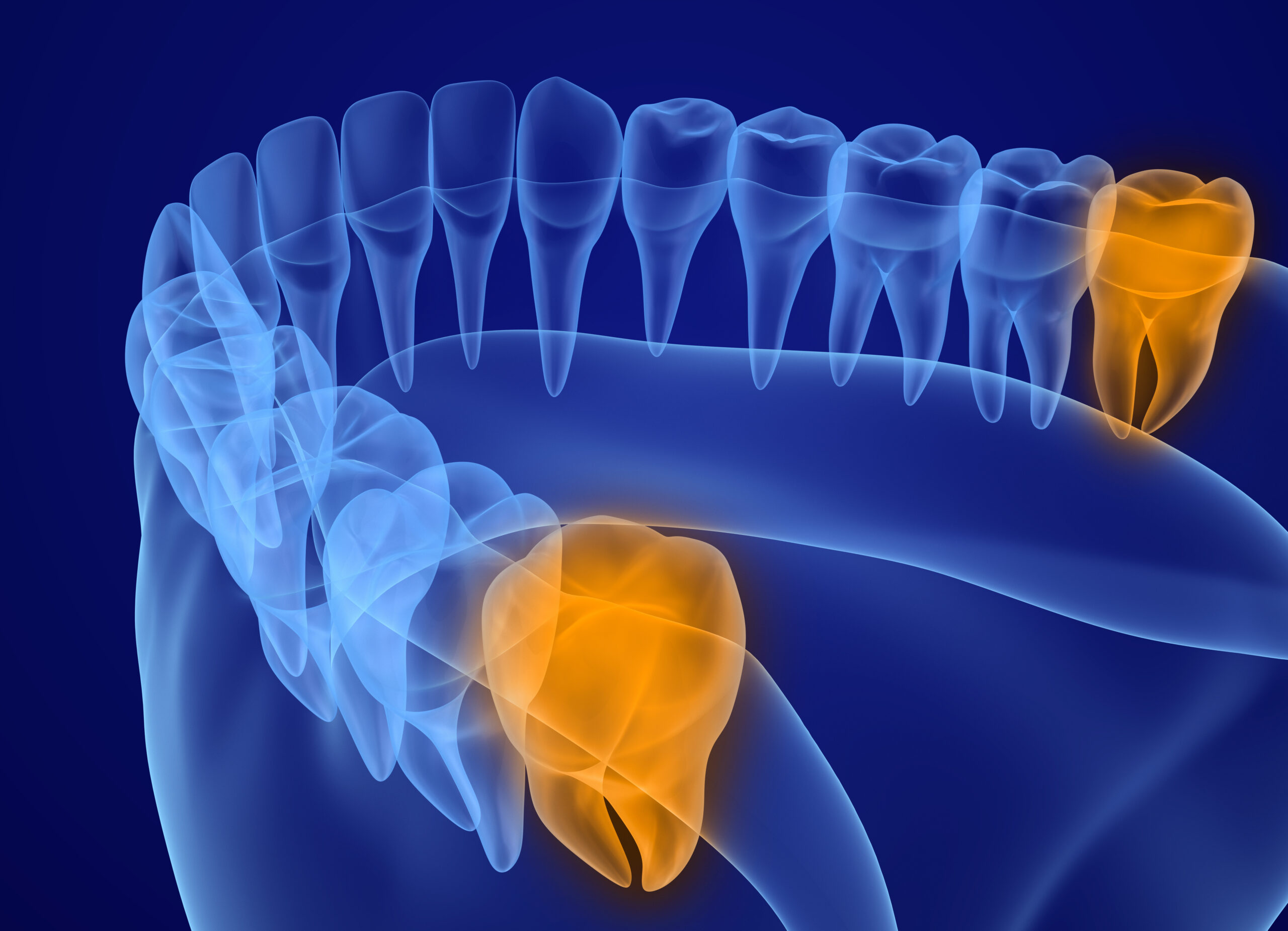 Wisdom tooth xray view. Medically accurate tooth 3D illustration