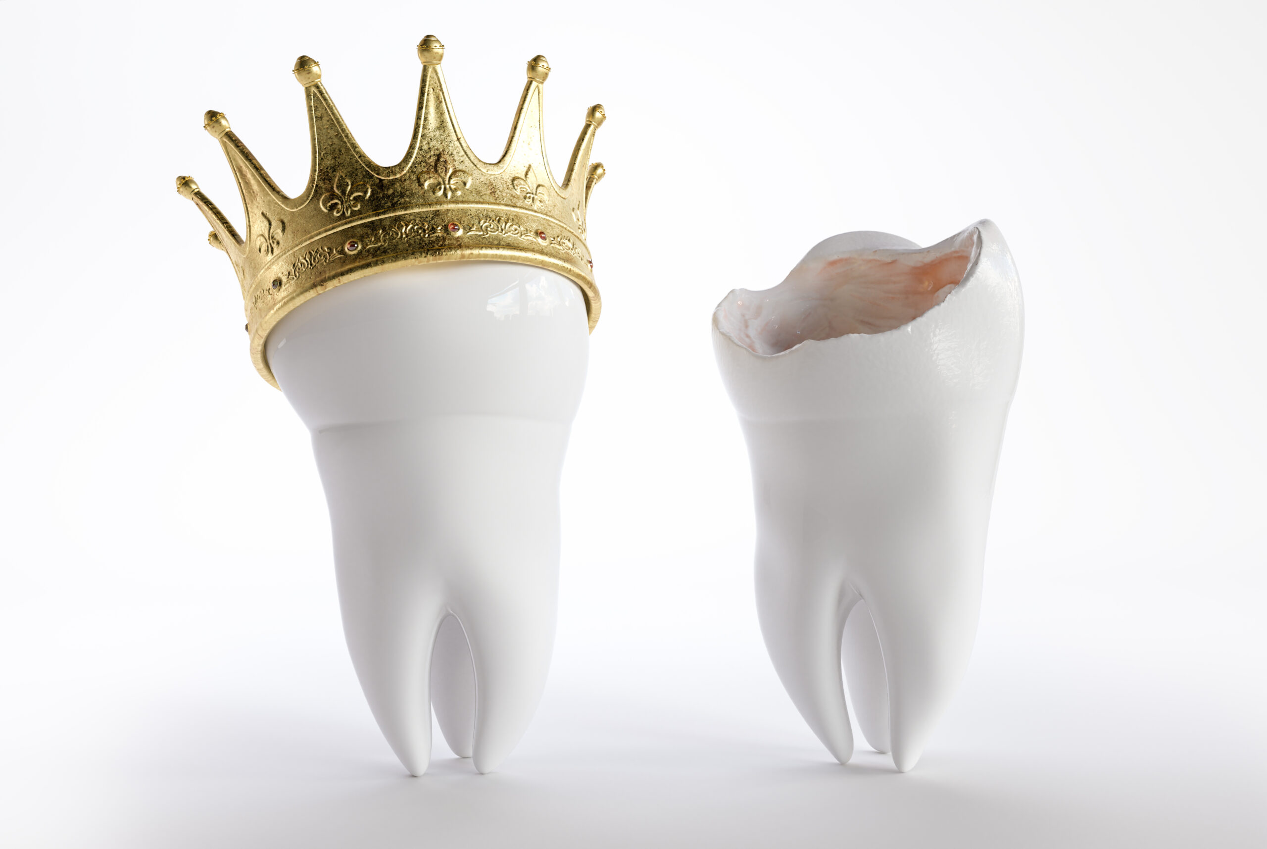 Tooth with a crown -- 3D Rendering