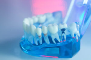 Dental teeth, mouth, gums dentists teaching model showing each tooth and root canal decay and inflamation.