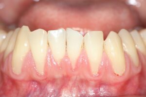 Gingival recession, also known as receding gums, is the exposure
