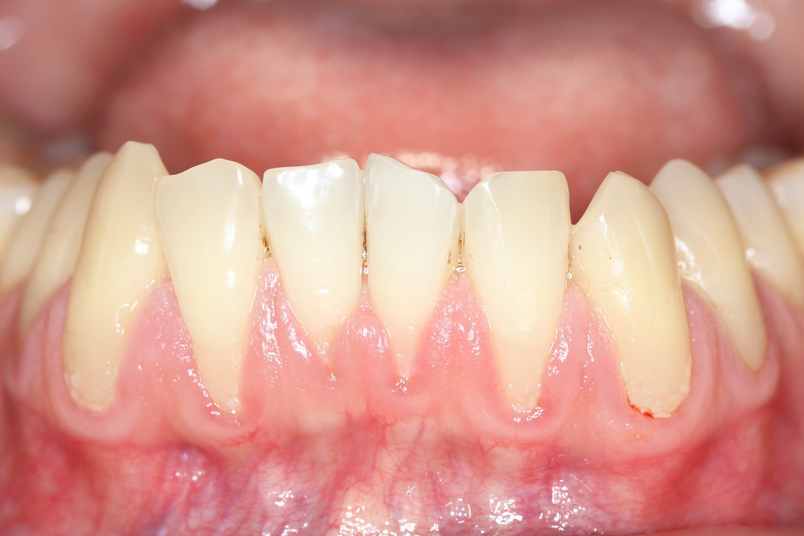 healthy gums